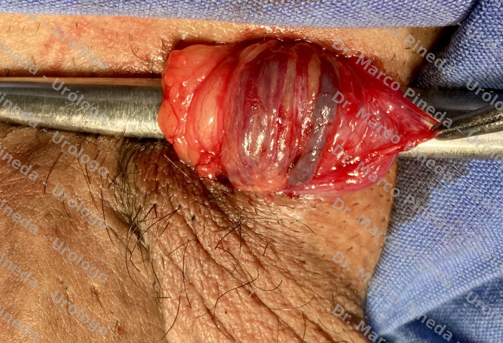 Varicocelectomía microquirúrgica caso 4